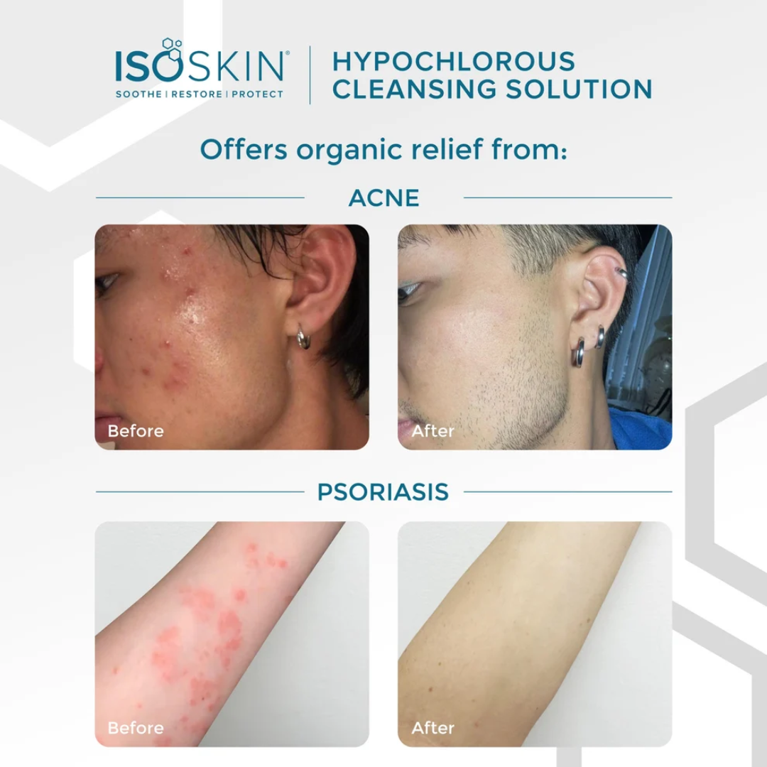ISOSKIN Hypochlorous Cleansing Solution
